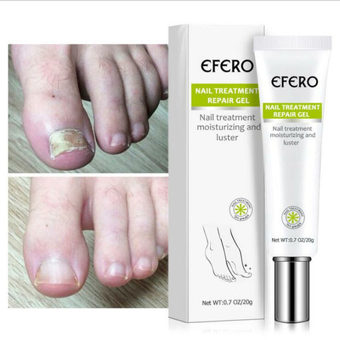 Efero 01 EFERO Fungal Nail Treatment Serum  Foot  Fungus Removal Gel Anti Infection Onychomycosis  Repair  Cream