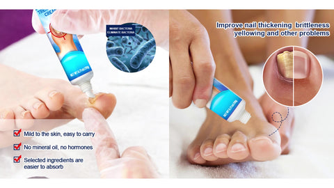 Sumifun Nail Fungus Treatment Cream 20g | Buy 1 Take 2